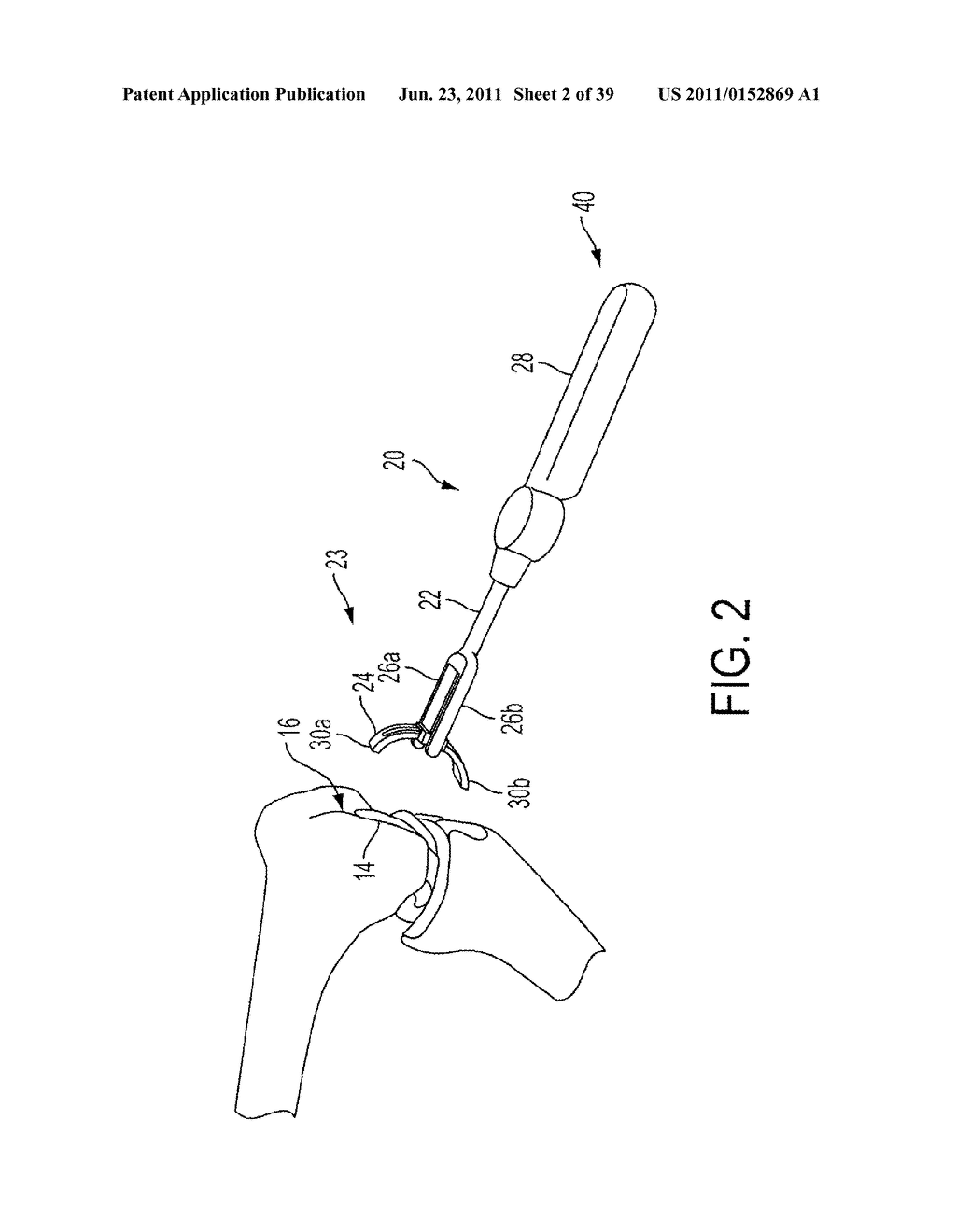 Bone Resurfacing System and Method - diagram, schematic, and image 03