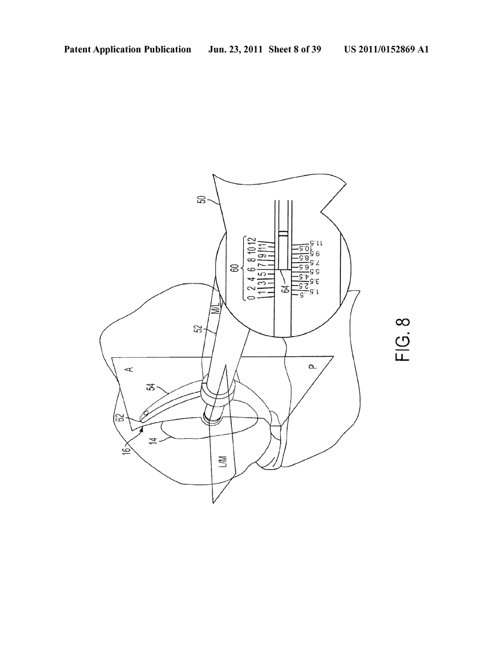 Bone Resurfacing System and Method - diagram, schematic, and image 09
