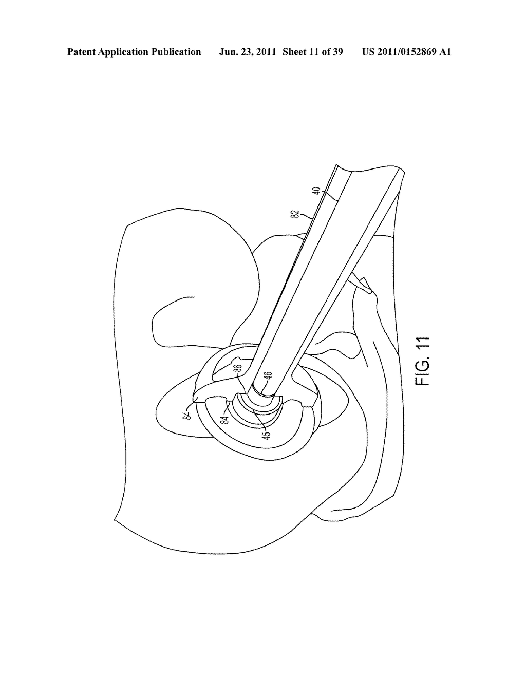 Bone Resurfacing System and Method - diagram, schematic, and image 12