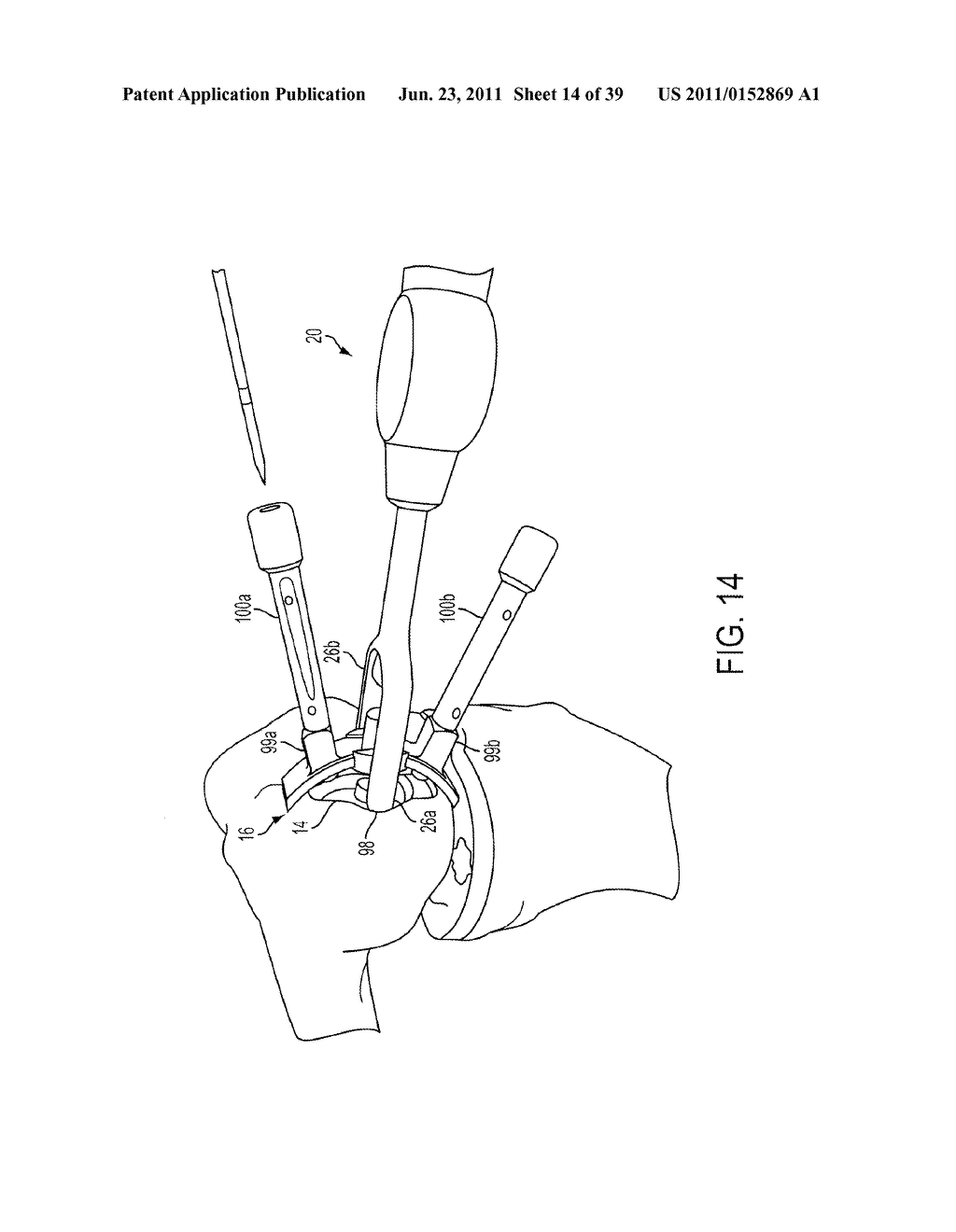 Bone Resurfacing System and Method - diagram, schematic, and image 15