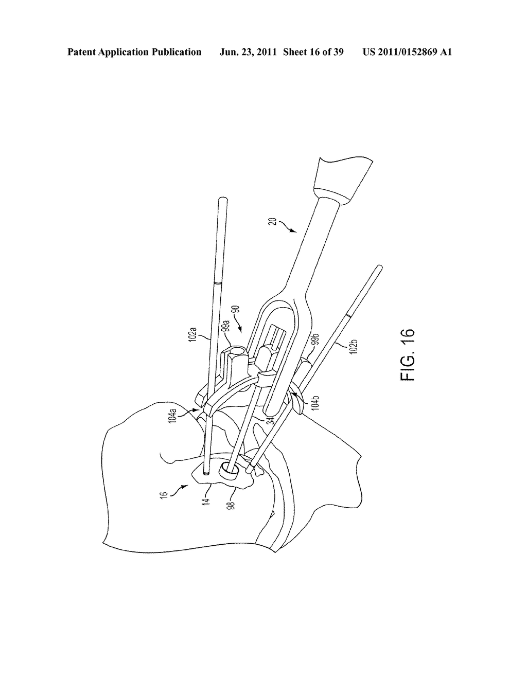 Bone Resurfacing System and Method - diagram, schematic, and image 17