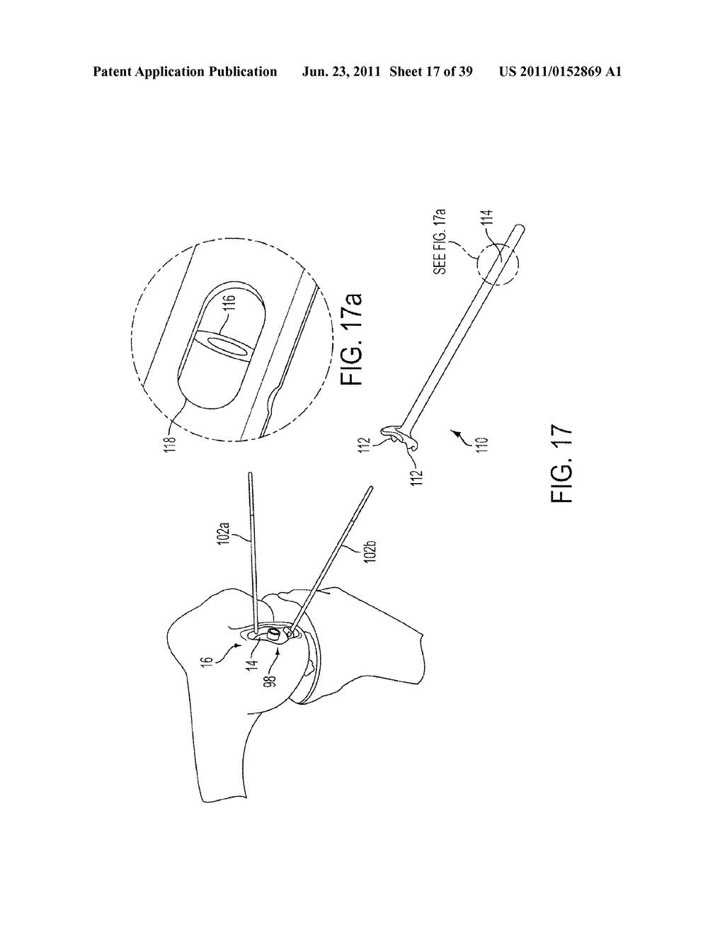 Bone Resurfacing System and Method - diagram, schematic, and image 18