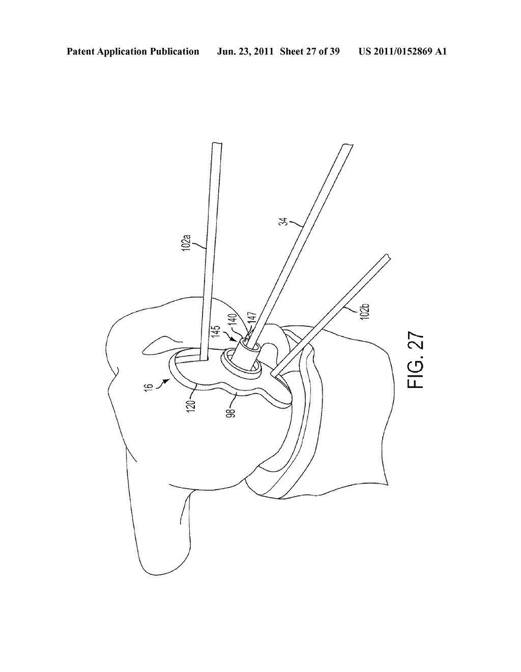 Bone Resurfacing System and Method - diagram, schematic, and image 28