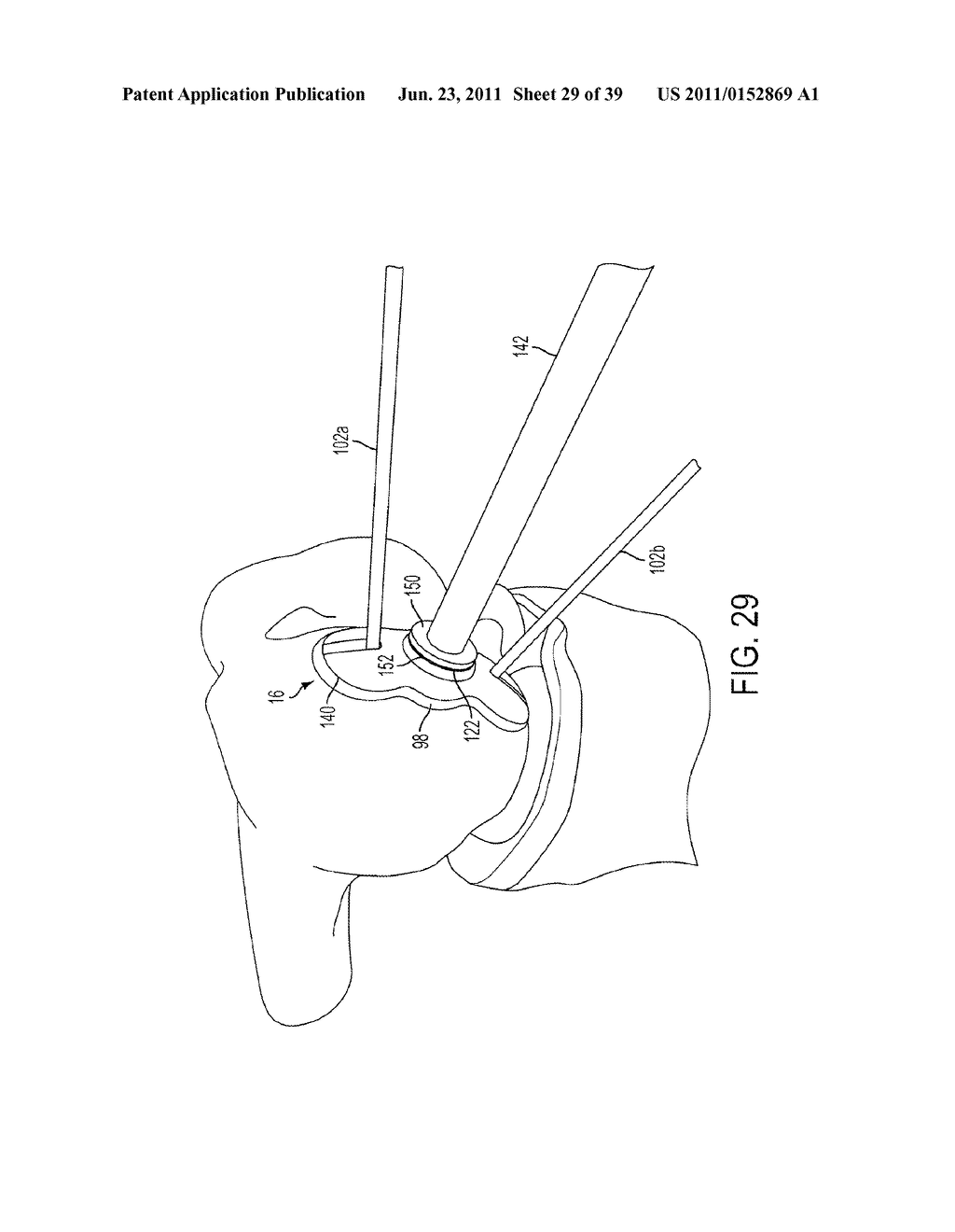 Bone Resurfacing System and Method - diagram, schematic, and image 30