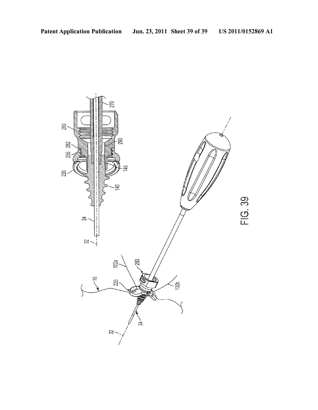 Bone Resurfacing System and Method - diagram, schematic, and image 40