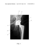 SURGICAL GUIDE SYSTEM USING AN ACTIVE ROBOT ARM diagram and image