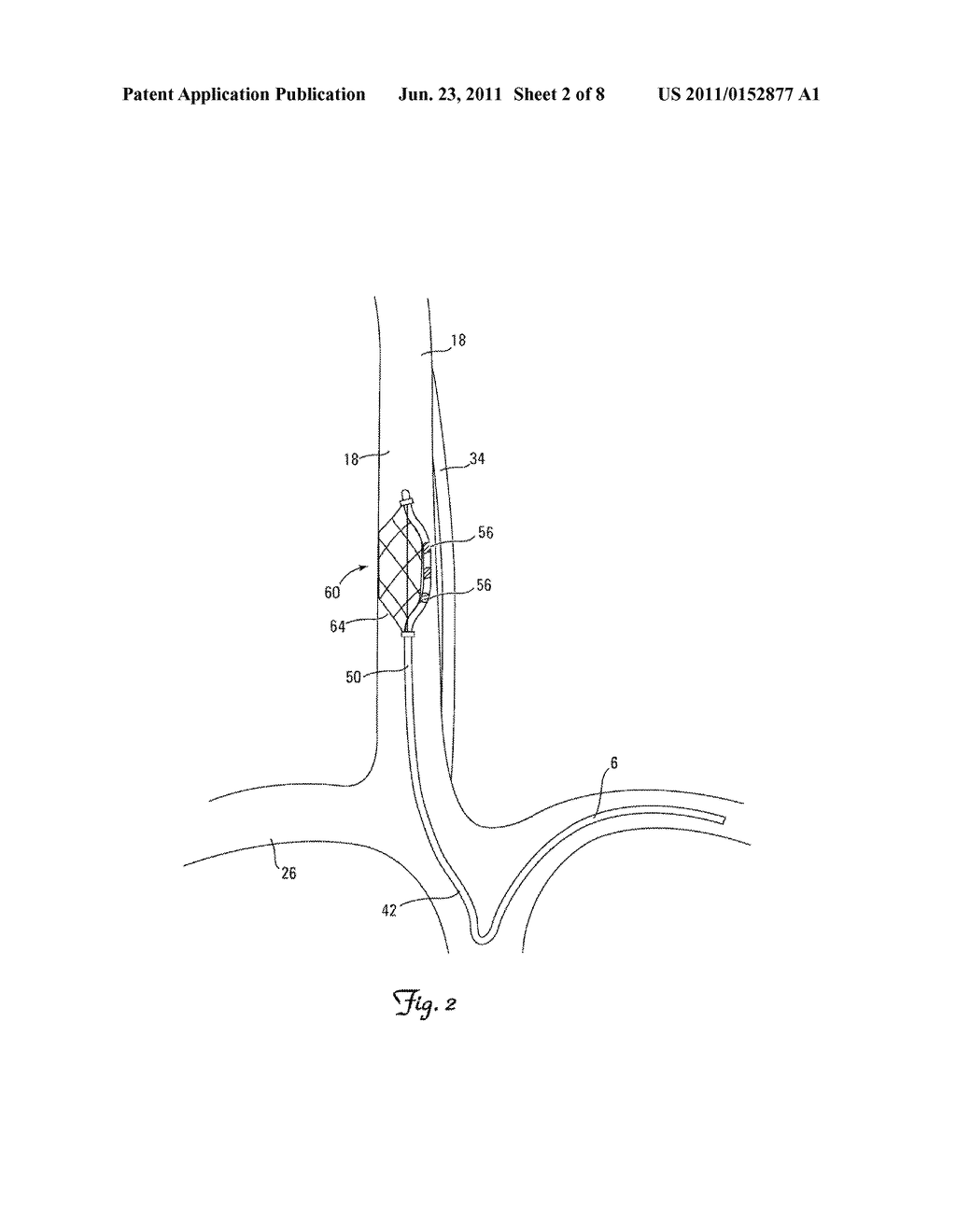 NEUROSTIMULATING LEAD HAVING A STENT-LIKE ANCHOR - diagram, schematic, and image 03