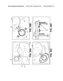 TISSUE EXPANDERS AND METHODS OF USE diagram and image