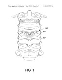 Flexible Spine Fixing Structure diagram and image