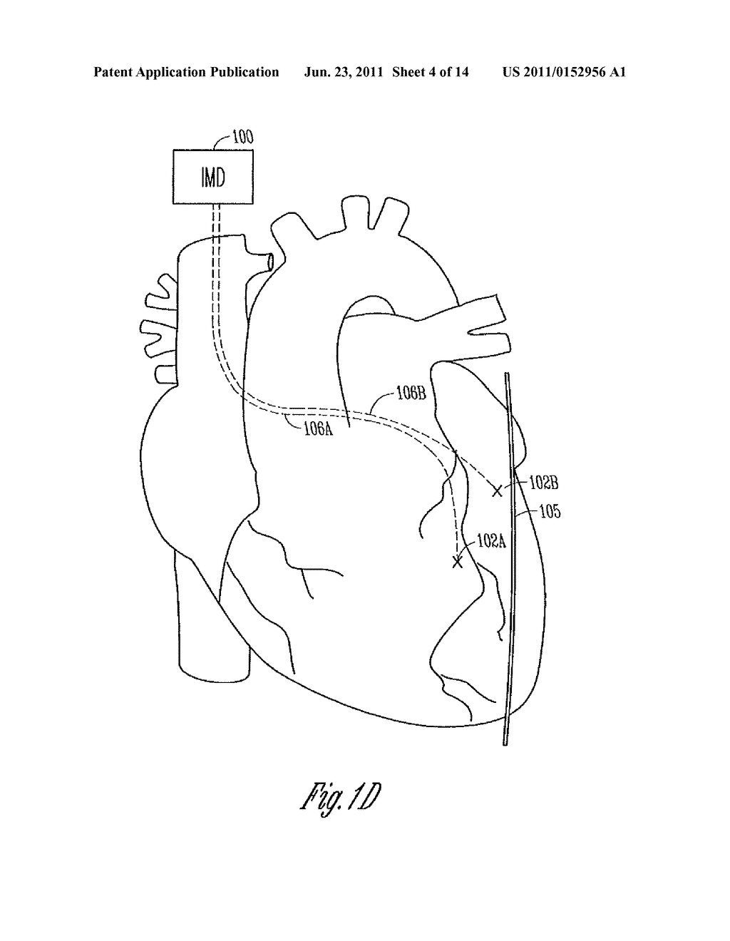 ELECTRICAL INIBITION OF THE PHRENIC NERVE DURING CARDIAC PACING - diagram, schematic, and image 05