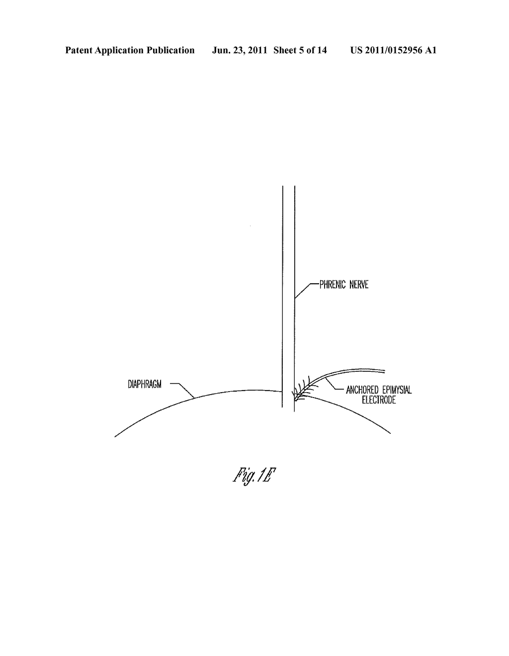 ELECTRICAL INIBITION OF THE PHRENIC NERVE DURING CARDIAC PACING - diagram, schematic, and image 06