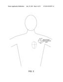 CHAOS-BASED DETECTION OF ATRIAL FIBRILLATION USING AN IMPLANTABLE MEDICAL     DEVICE diagram and image