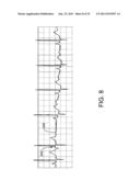 CHAOS-BASED DETECTION OF ATRIAL FIBRILLATION USING AN IMPLANTABLE MEDICAL     DEVICE diagram and image