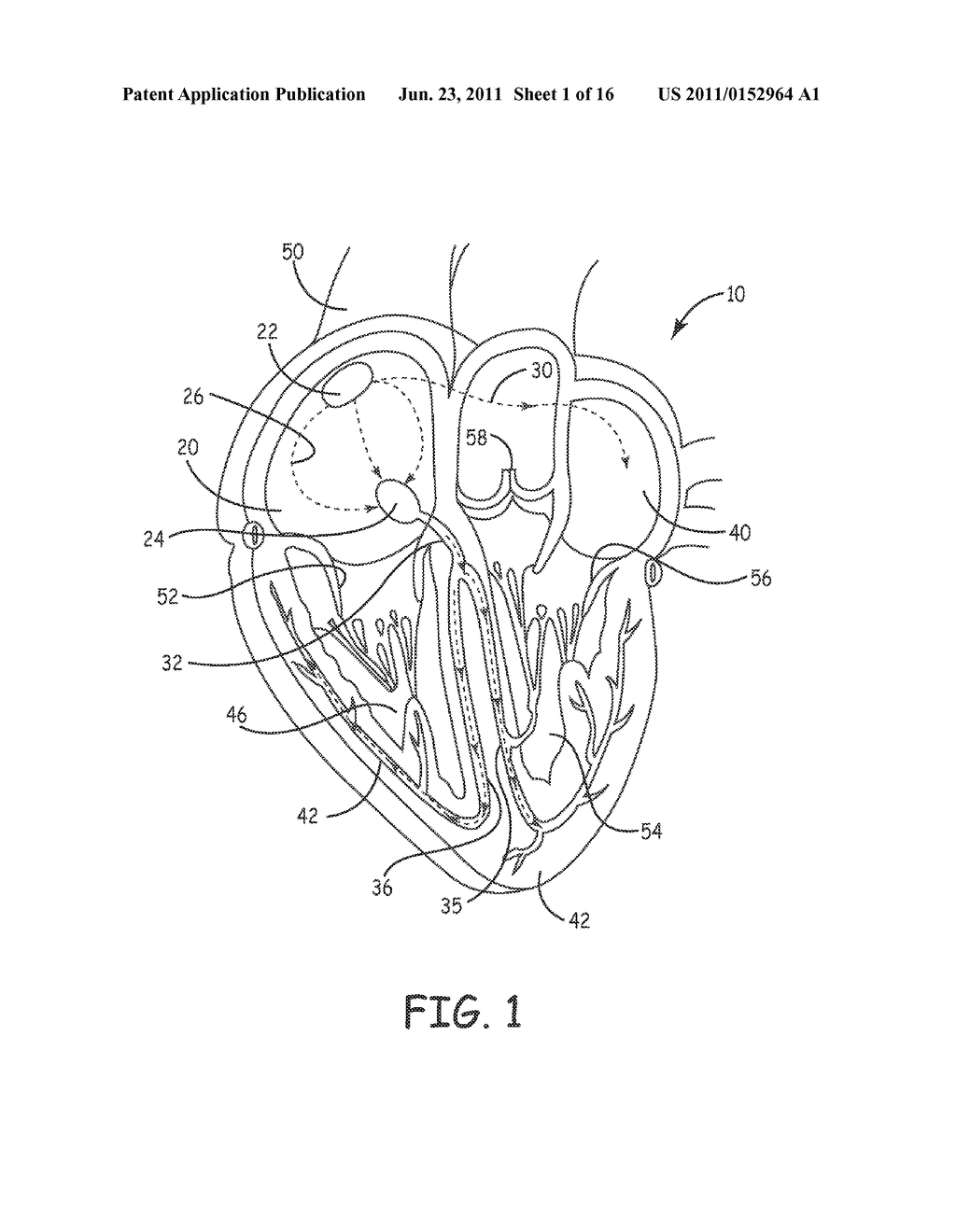 SYSTEM AND METHOD OF AV INTERVAL SELECTION IN AN IMPLANTABLE MEDICAL     DEVICE - diagram, schematic, and image 02