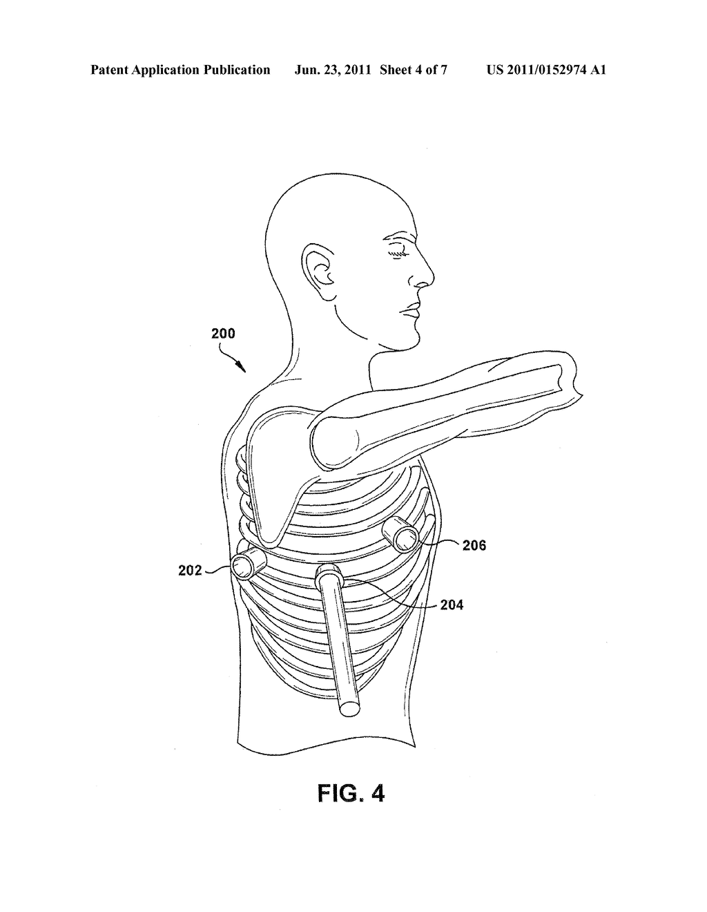 METHODS OF TREATING MEDICAL CONDITIONS BY NEUROMODULATION OF THE     SYMPATHETIC NERVOUS SYSTEM - diagram, schematic, and image 05