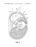 METHODS OF TREATING MEDICAL CONDITIONS BY NEUROMODULATION OF THE     SYMPATHETIC NERVOUS SYSTEM diagram and image