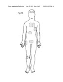 THERAPEUTIC DEVICE AND METHOD diagram and image