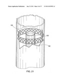 DEVICE AND METHOD FOR TACKING PLAQUE TO BLOOD VESSEL WALL USING WIRE MESH     ANNULAR BAND diagram and image