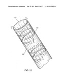 DEVICE AND METHOD FOR TACKING PLAQUE TO BLOOD VESSEL WALL USING WIRE MESH     ANNULAR BAND diagram and image