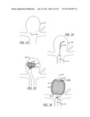 MULTIPLE LAYER FILAMENTARY DEVICES OR TREATMENT OF VASCULAR DEFECTS diagram and image