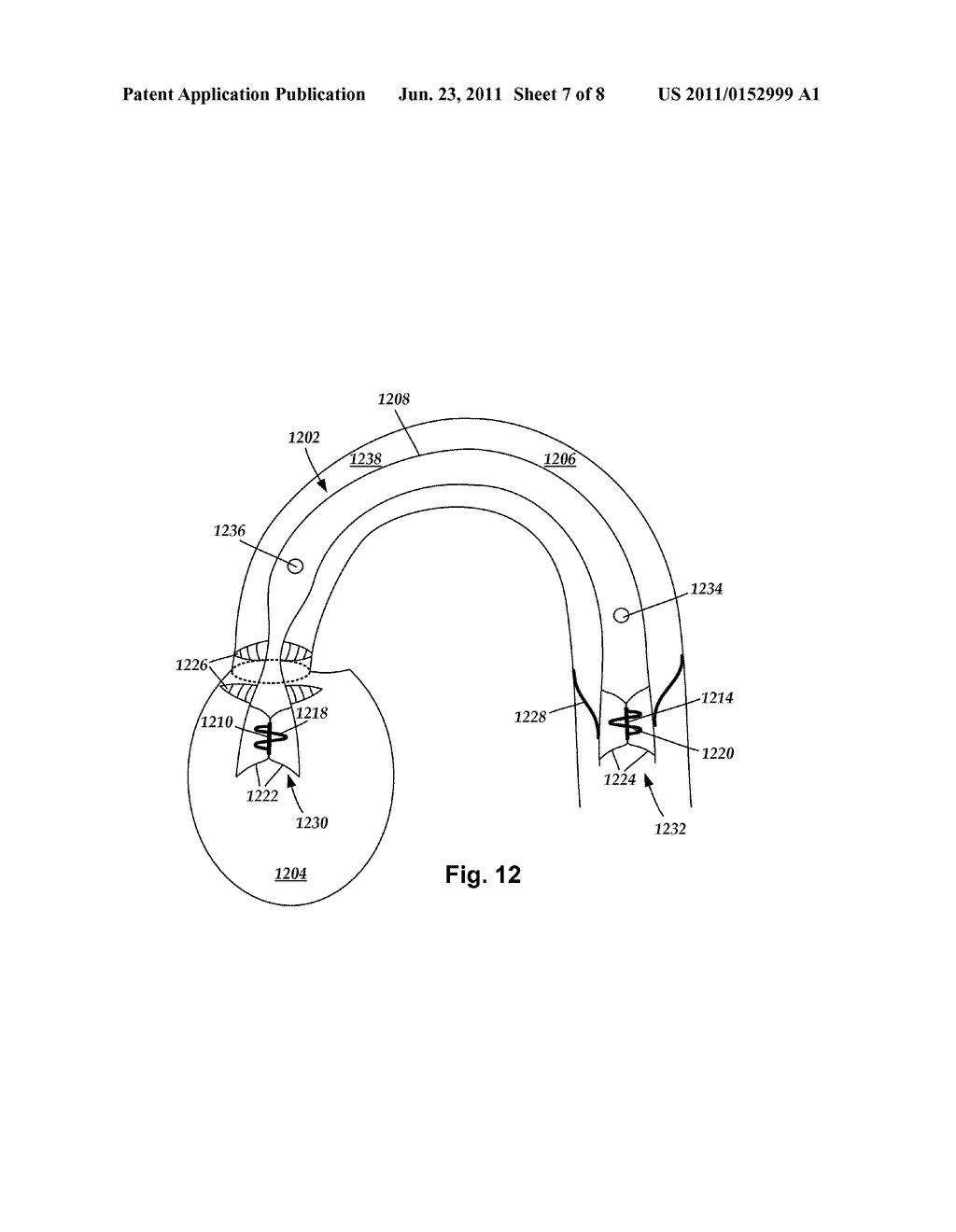 SYSTEMS AND METHODS FOR MAKING AND USING PERCUTANEOUSLY-DELIVERED PUMPING     SYSTEMS FOR PROVIDING HEMODYNAMIC SUPPORT - diagram, schematic, and image 08