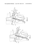 Method and Apparatus for Graft Fixation diagram and image