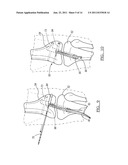 Method and Apparatus for Graft Fixation diagram and image