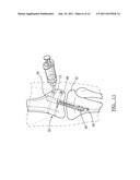 Method and Apparatus for Graft Fixation diagram and image