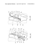 Method and Apparatus for Graft Fixation diagram and image