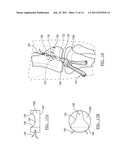 Method and Apparatus for Graft Fixation diagram and image