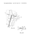 Method and Apparatus for Graft Fixation diagram and image