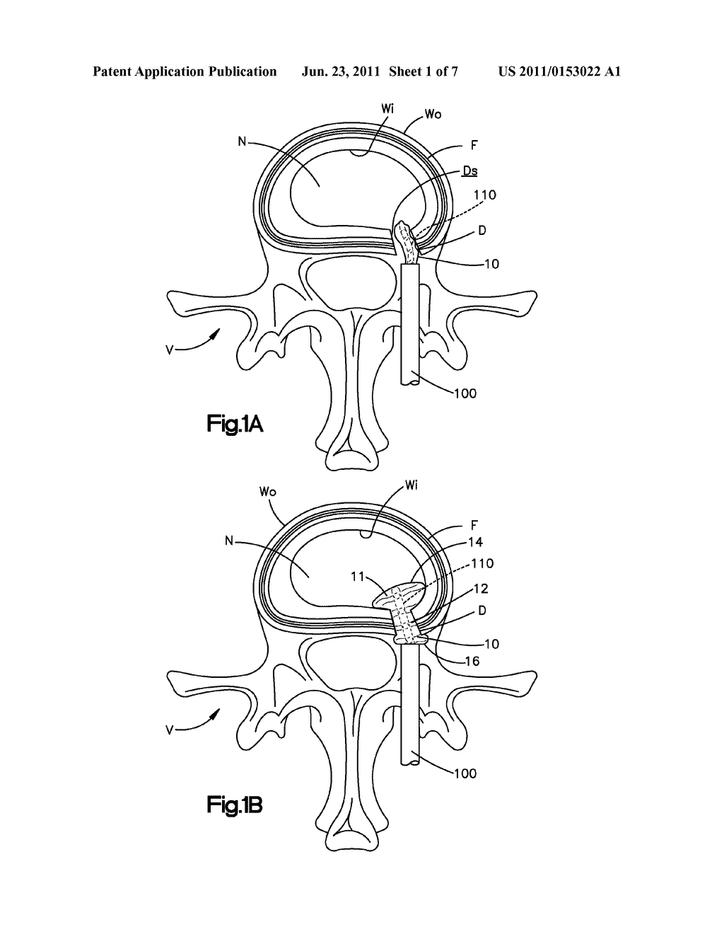 BALLOON-ASSISTED ANNULUS REPAIR - diagram, schematic, and image 02