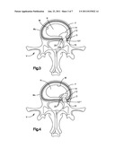 BALLOON-ASSISTED ANNULUS REPAIR diagram and image