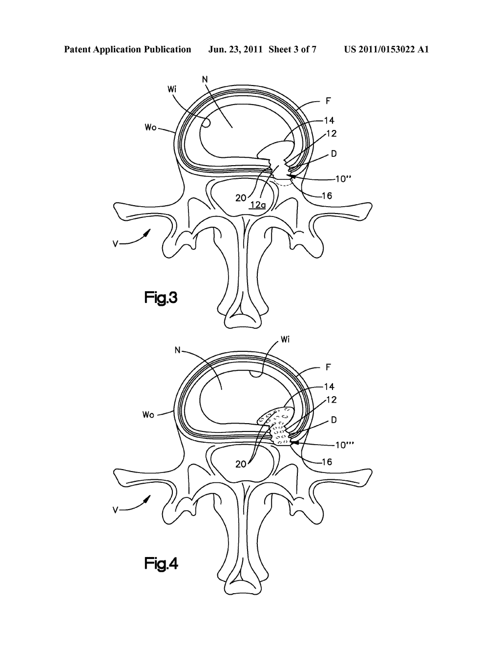 BALLOON-ASSISTED ANNULUS REPAIR - diagram, schematic, and image 04