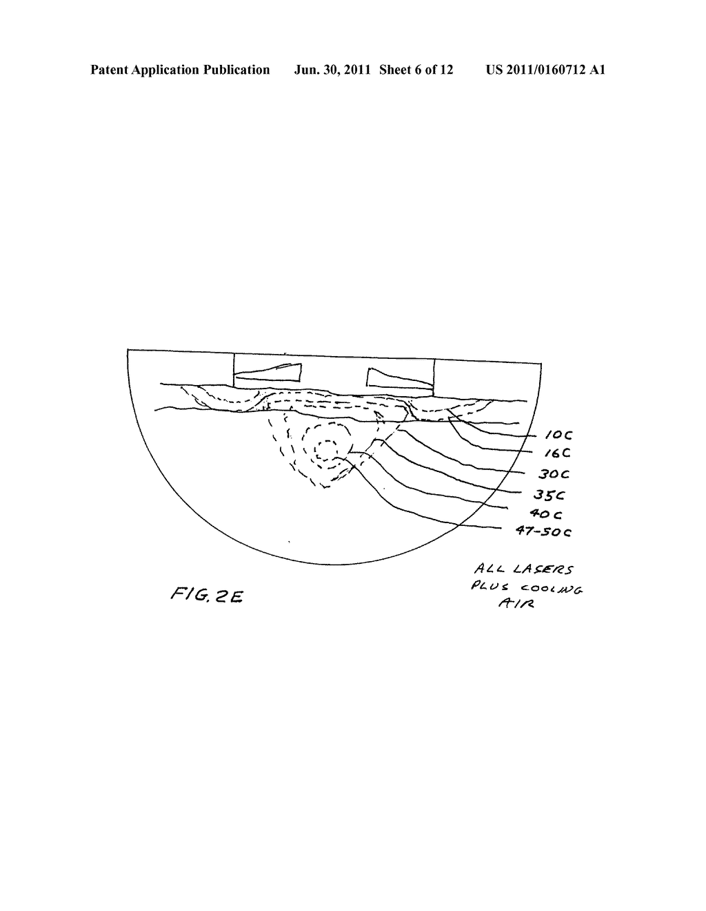 Laser treatment system and method for producing thermal cavities and     energy droplets - diagram, schematic, and image 07