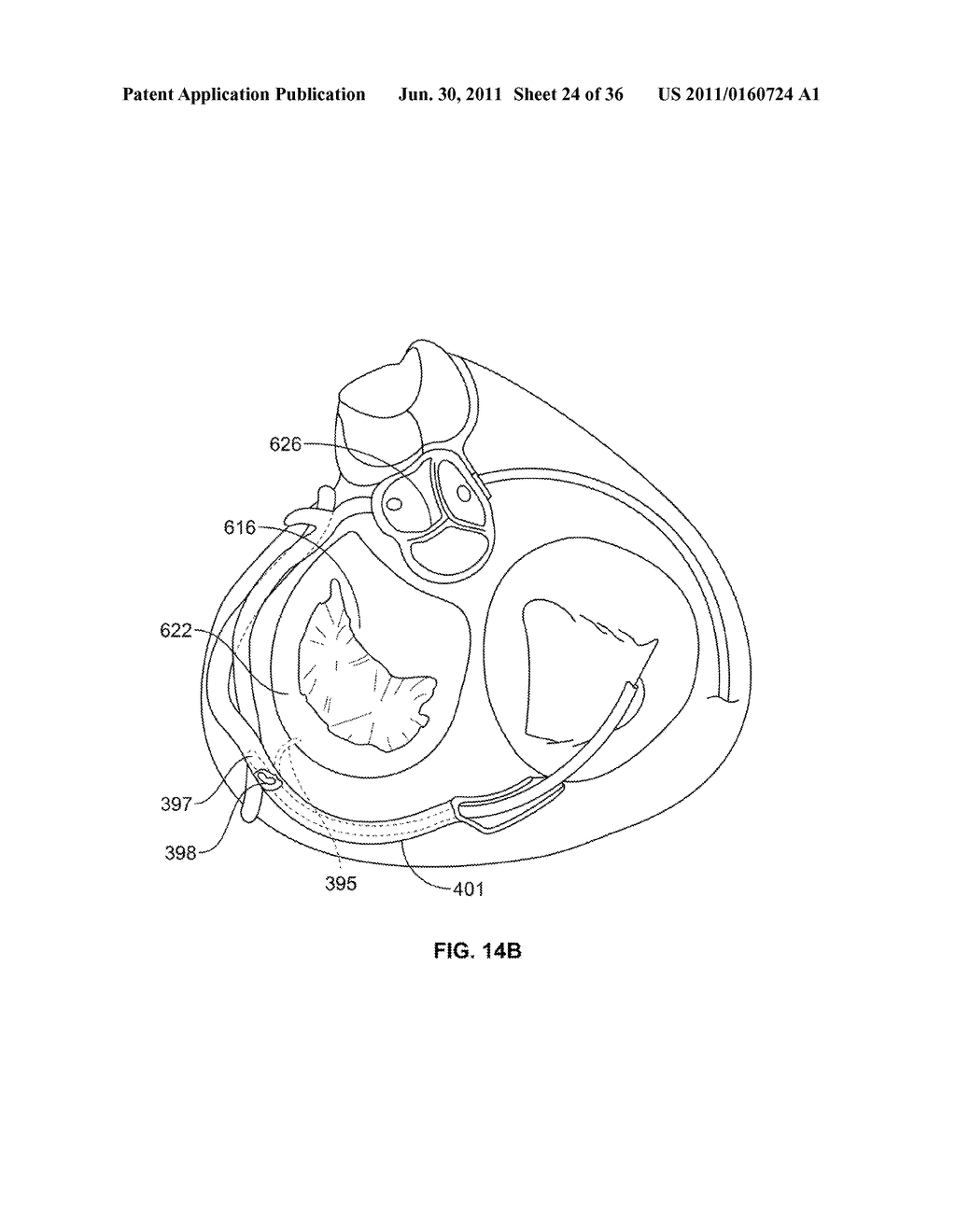 SYSTEM AND METHOD FOR DENATURING AND FIXING COLLAGENOUS TISSUE - diagram, schematic, and image 25