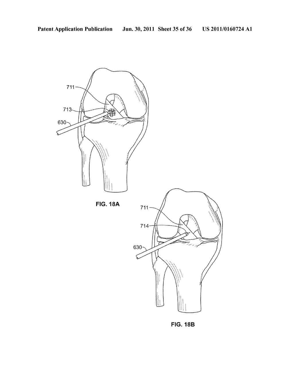 SYSTEM AND METHOD FOR DENATURING AND FIXING COLLAGENOUS TISSUE - diagram, schematic, and image 36