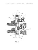 Intramedullary Nail and Protruding Screw Locking Mechanism diagram and image