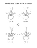 DEVICES AND METHODS FOR TISSUE ACCESS diagram and image