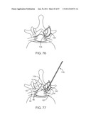 DEVICES AND METHODS FOR TISSUE ACCESS diagram and image