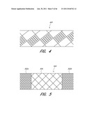 METHOD FOR PROVIDING PROGRESSIVE THERAPY FOR THROMBUS MANAGEMENT diagram and image