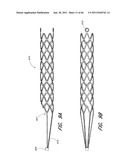 METHOD FOR PROVIDING PROGRESSIVE THERAPY FOR THROMBUS MANAGEMENT diagram and image