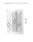 METHOD FOR PROVIDING PROGRESSIVE THERAPY FOR THROMBUS MANAGEMENT diagram and image