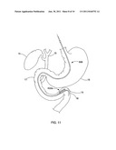 ELONGATE MAGNET FOR A MAGNETIC ANASTOMOSIS DEVICE diagram and image