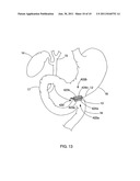 ELONGATE MAGNET FOR A MAGNETIC ANASTOMOSIS DEVICE diagram and image