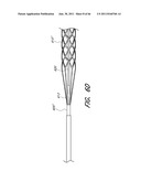 SYSTEM FOR PROVIDING PROGRESSIVE THERAPY FOR THROMBUS MANAGEMENT diagram and image