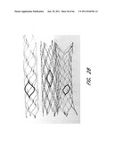 SYSTEM FOR PROVIDING PROGRESSIVE THERAPY FOR THROMBUS MANAGEMENT diagram and image