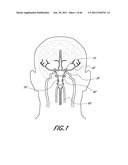 MULTIPLE LAYER EMBOLUS REMOVAL diagram and image