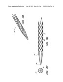 MULTIPLE LAYER EMBOLUS REMOVAL diagram and image