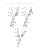 APPARATUS AND METHODS FOR REDUCING EMBOLIZATION DURING TREATMENT OF     CAROTID ARTERY DISEASE diagram and image